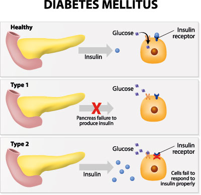 Diabetes vom Typ 1