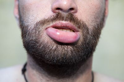 Geschwollen lippe gebissen Auf Lippe