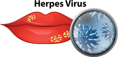 Herpes verbreitung