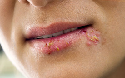 Mund herpes heilt nicht am Lippenherpes: Auslöser,