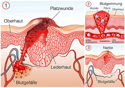 Platzwunde Ursachen Symptome Behandlung Medlexi De