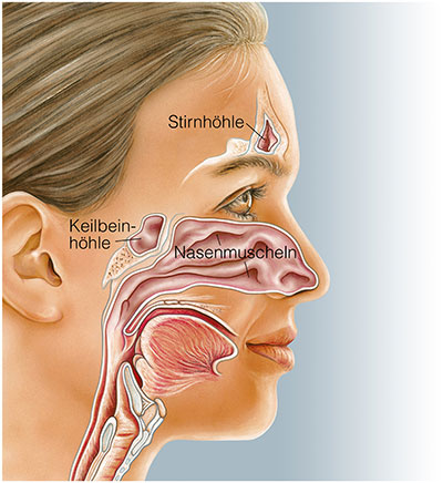 Der blutige nase in verkrustungen Nasenschleimhautentzündung