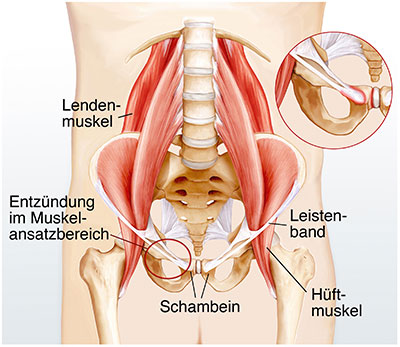 Schambeinentzundung Ursachen Symptome Behandlung Medlexi De