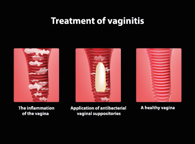 Von innen geschwollen scheide Vaginitis (Entzündungen