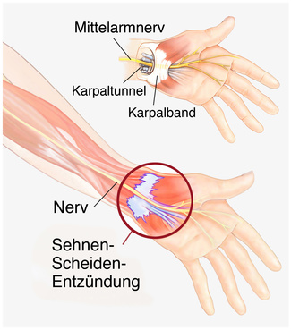 Lange wie entzündet sehnenscheide gips handgelenk Wie lang