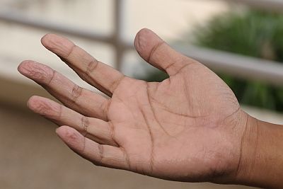 Waschfrauenhande Ursachen Behandlung Hilfe Medlexi De