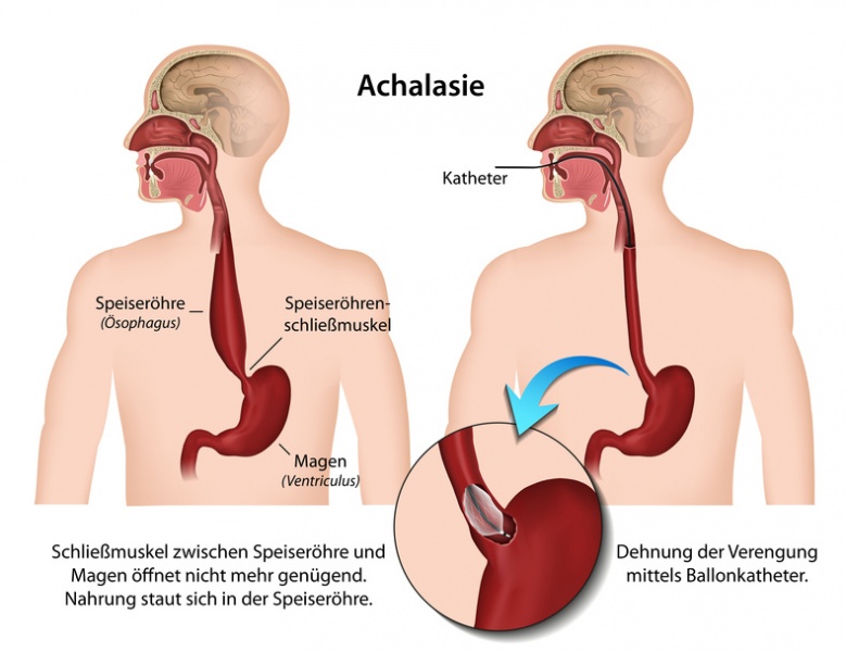 Datei:Achalasie.jpg