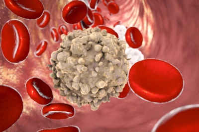 Akute lymphatische Leukämie - Ursachen, Symptome & Behandlung | MedLexi.de