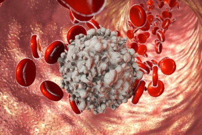 Akute myeloische Leukämie Ursachen, Symptome & Behandlung MedLexi.de