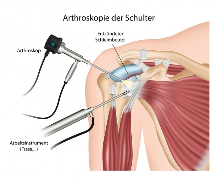 Datei:Arthroskopie Schulter.jpg