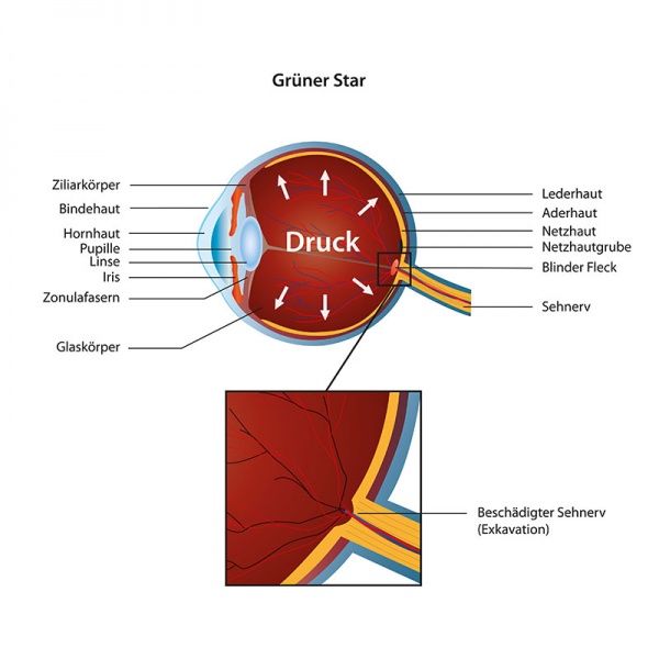 Datei:Augeninnendruck.jpg