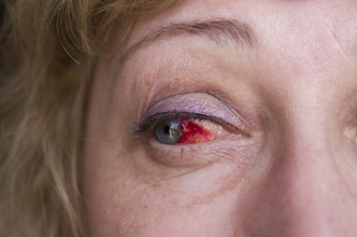 Blut im Auge - Ursachen, Behandlung & Hilfe