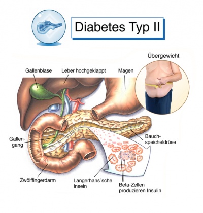 Diabetes Typ 2 Ursachen