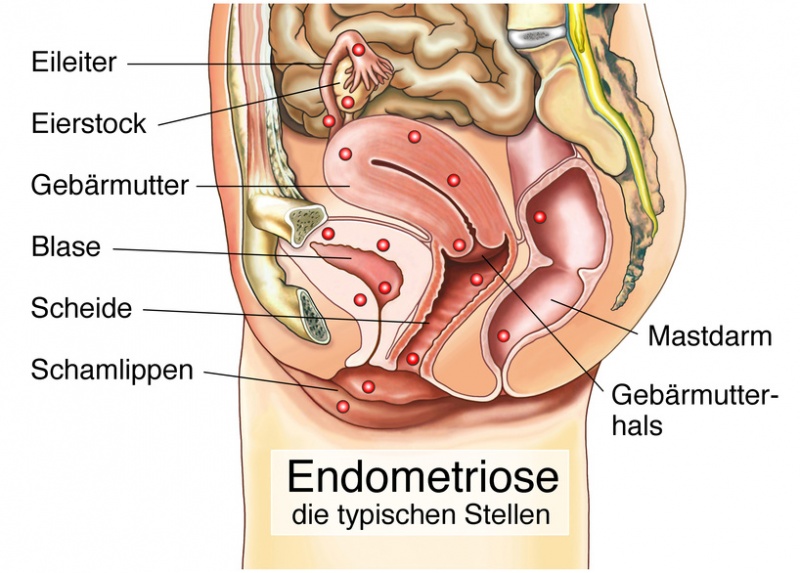 Datei:Endometriose.jpg