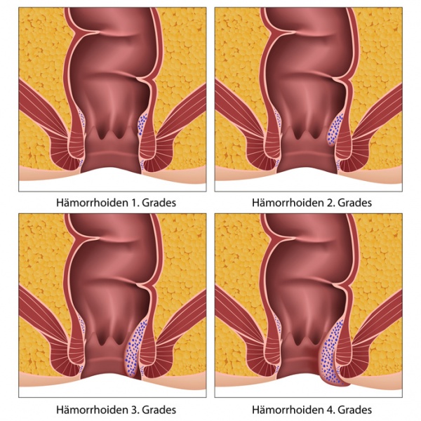 Datei:Haemorrhoiden.jpg