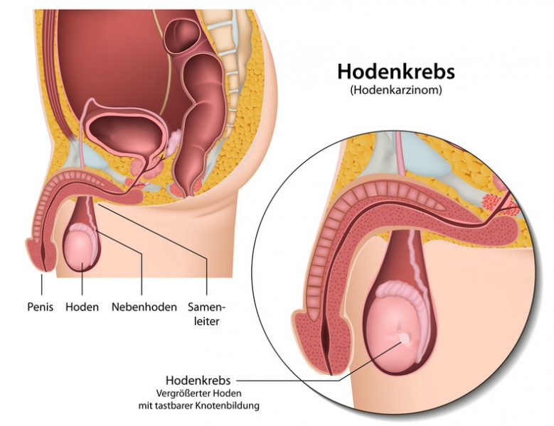 Datei:Hodenkrebs.jpg