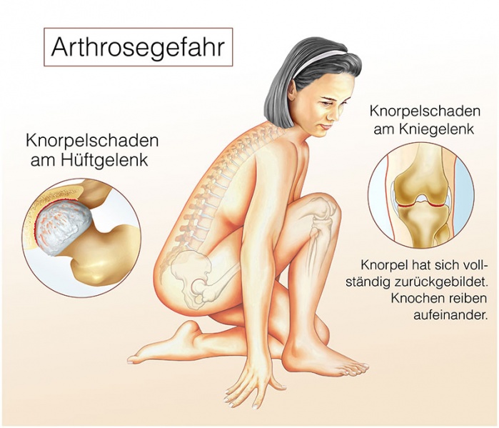 Datei:Hueftgelenk.jpg