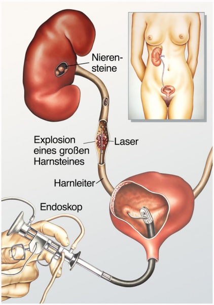 Datei:Ureteroskopie.jpg